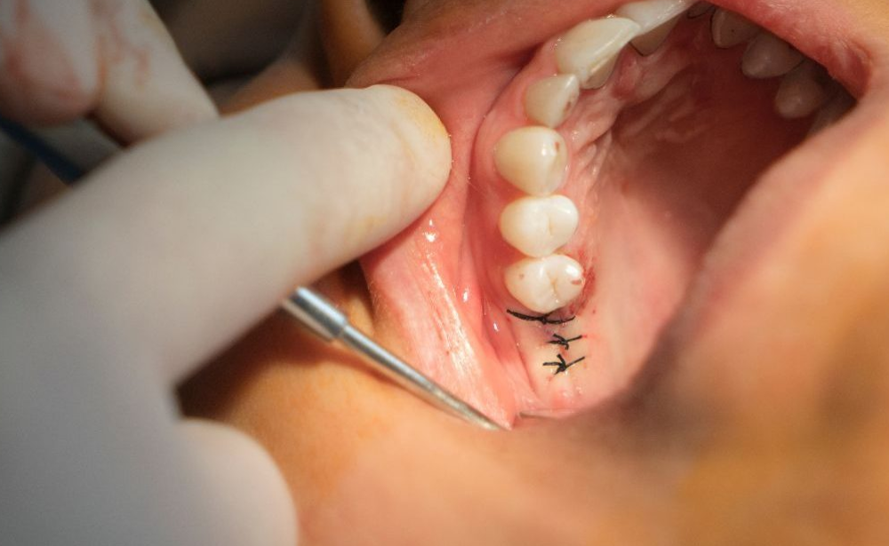 Imagen de cirugía dental