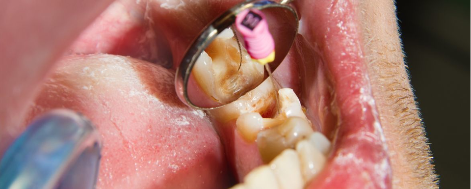 Imagen de Endodoncia