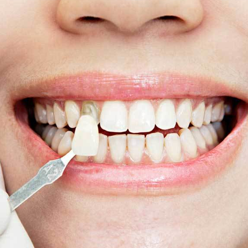 Imagen de una Carilla