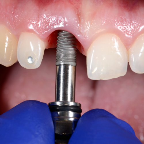 Implante dental
