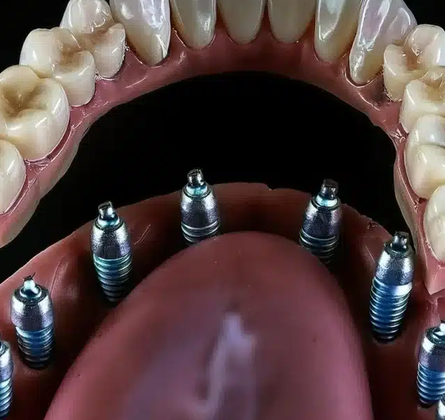 Implantes Dentales