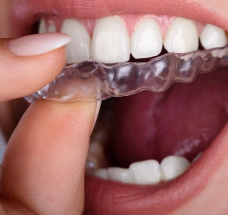 Ortodoncia Invisible