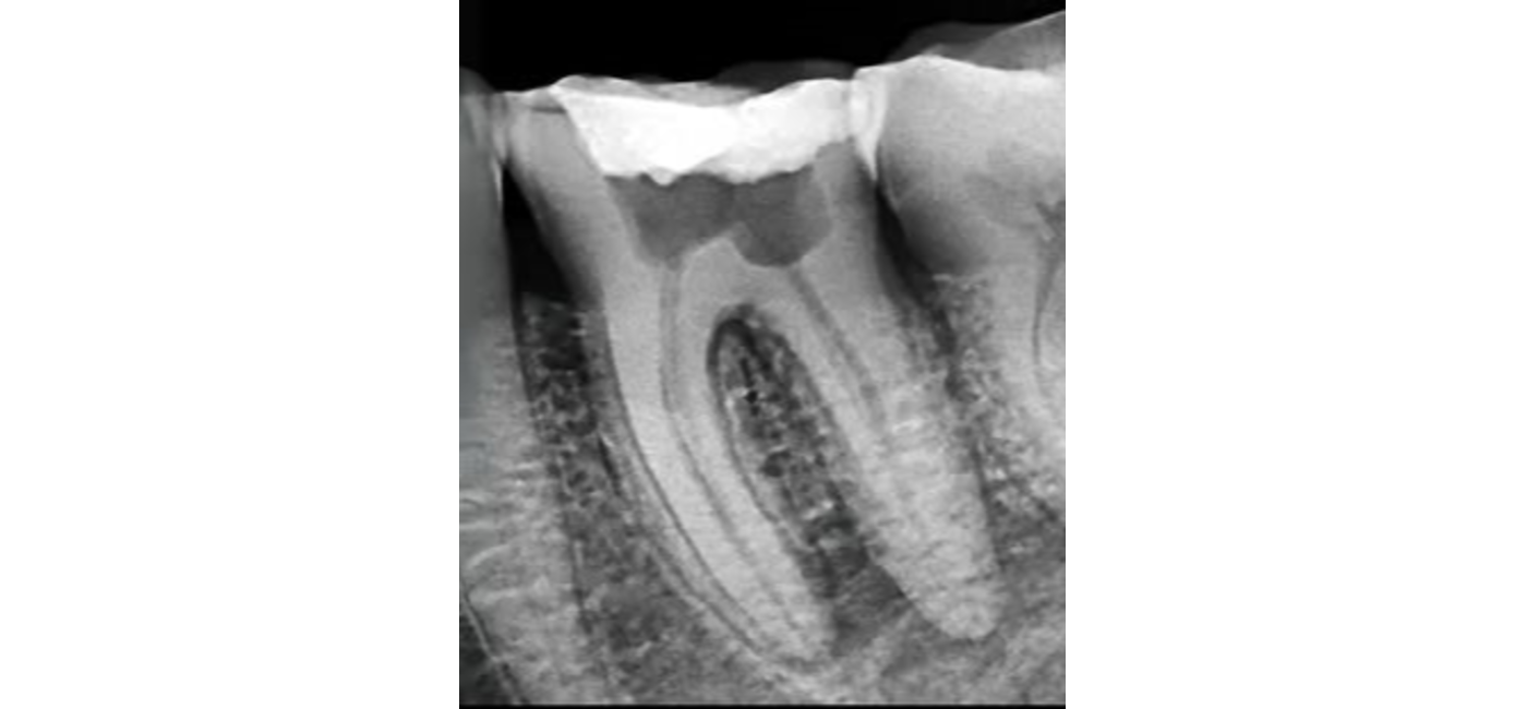 Root Canal