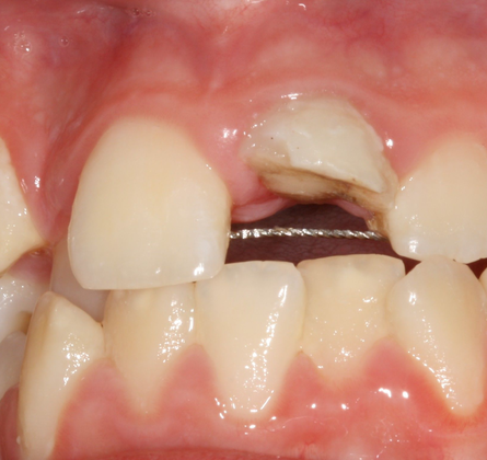 Traumatismos Dentales