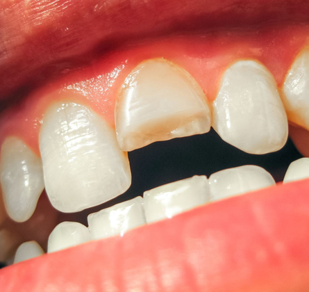 Traumatismos Dentales