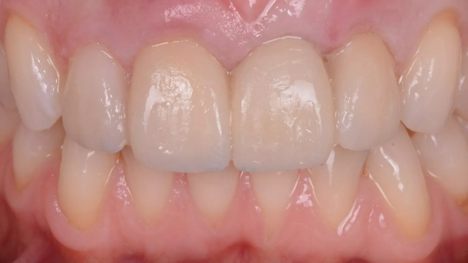 Traumatismos Dentales